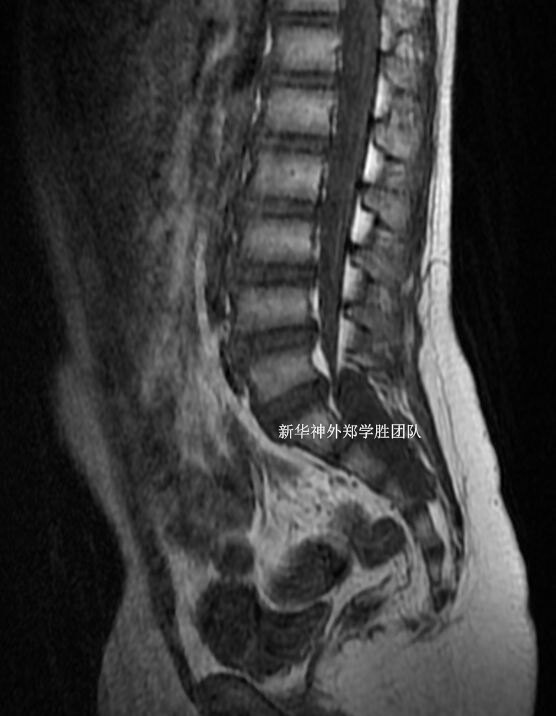 骶管囊肿最新疗法揭秘